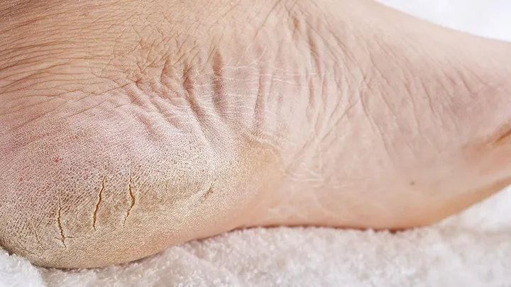 Molestas y dolorosas: ¡ fisuras en el talón ! Este remedio natural brinda alivio instantáneo