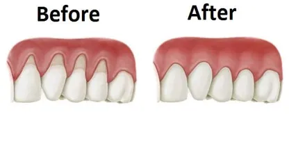 Do you have receding gums? This natural remedy might just be the solution