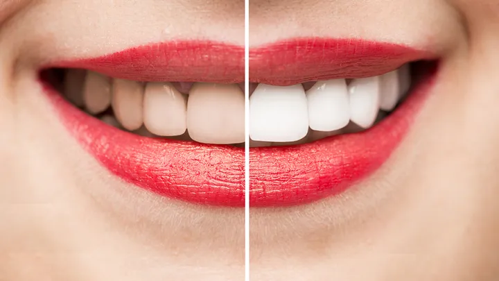 10 formas naturales de blanquear los dientes en casa