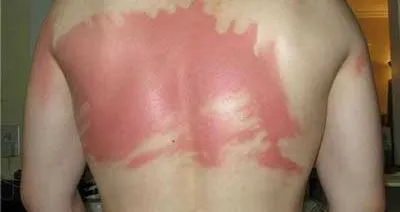 Met dit  simpele trucje kun je zonnebrandcrème op je eigen rug smeren! Ideaal!