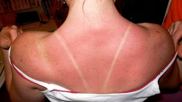 This is why you should never peel your skin when you have a sunburn