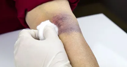 Kühlen, wärmen und einschmieren: so wirst du deine blaue Flecken schneller los