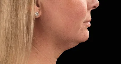 Wow! Mit diesen Tricks wird der Doppelkinn weniger sichtbar!