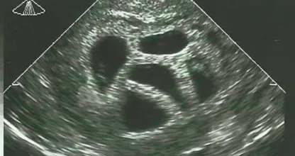 This mom refused to abort her quintuplets. Twenty years later, she shows this picture! Wow, this is amazing!