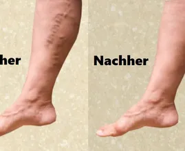 Mit diesem Trick wirst du deine Krampfadern leichter wieder los!