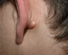 Do you sometimes have a strange little bump behind your ear? THIS is what it means!