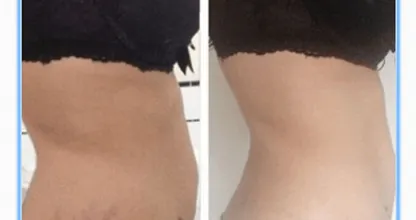 Wauw, je hebt maar één product nodig om van je cellulite af te komen!! Dit moet je zeker eens proberen!
