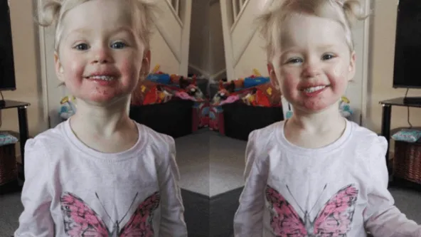 Wat afschuwelijk dit... een familielid met herpes verwoestte het gezicht van 3-jarige Sienna!