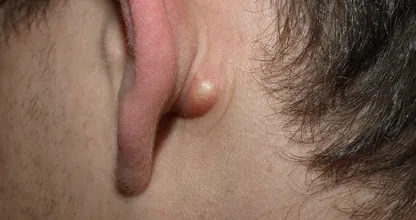 Do you sometimes have a strange little bump behind your ear? THIS is what it means!