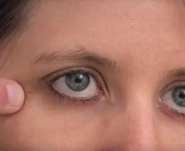 Questo trucco può aiutarti a rimuovere milia da solo