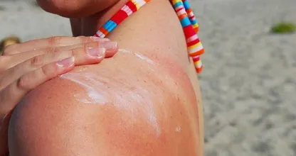 Oei, verbrand? Met deze TikTok-hack verlicht je binnen 10 seconden de pijn