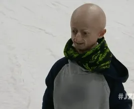 De 19-jarige Michiel lijkt hoogbejaard door zeldzame ziekte