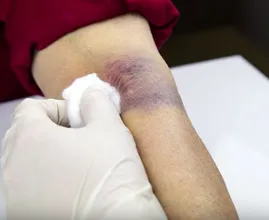 Kühlen, wärmen und einschmieren: so wirst du deine blaue Flecken schneller los