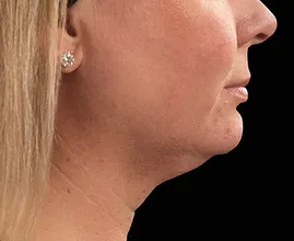 Wow! Mit diesen Tricks wird der Doppelkinn weniger sichtbar!