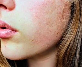 Deze 5 huidproblemen wijzen op een vitamine D-tekort