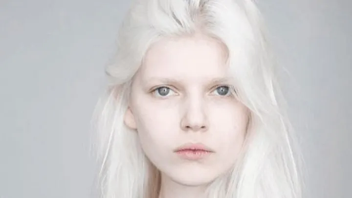 20 People With Unique Genetic Traits That Are Hard to Forget