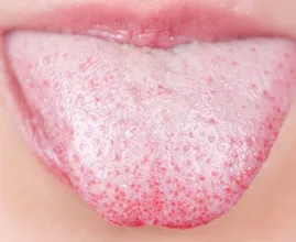 THIS is what a white tongue says about your health! Very few people know this!