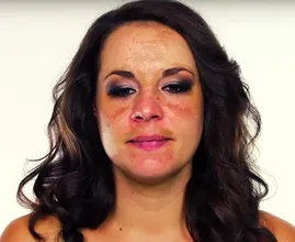 Pigment mustache: with these tips you can remove discoloration above the lip