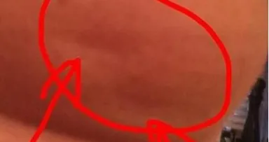 Bitte Teilen: wenig bekanntes Symptom! Mini Delle an der Brust als Brustkrebs erkannt!