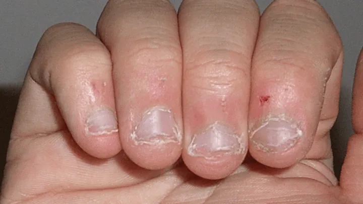 Verslavend maar het ziet er niet uit: nagelbijten! Zo kom je makkelijk van deze nare gewoonte af!