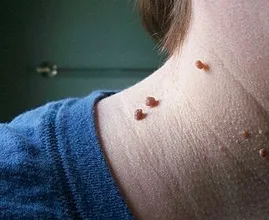 Brodawki I Włókniaki Jeszcze Nigdy Nie Były Tak Łatwe W Usuwaniu! Ten Trik Zdradza, Jak Pozbyć Się Ich Całkowicie Bezboleśnie!