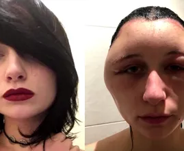 Studente Estelle kreeg een ‘hoofd als een gloeilamp’ na heftige allergische reactie op haarverf