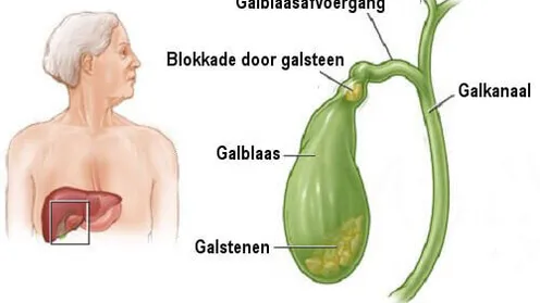 Heb jij wel eens last van één van deze symptomen? Dan kan het zijn dat je galstenen hebt! Belangrijk, dit moet je lezen!
