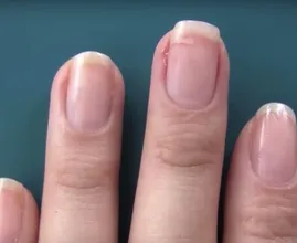 Ouch, a torn nail! With this weird trick you could repair it in no time