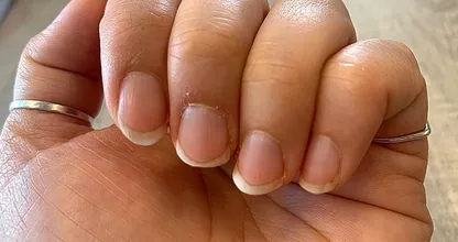 Last van een nagelriemontsteking? Dit is alles wat je erover moet weten