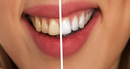 Queste cose possono far ingiallire i denti