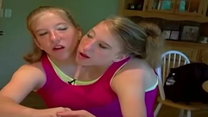 Jaren nadat deze Siamese tweeling was geboren, delen ze verbazingwekkend nieuws