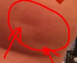 Bitte Teilen: wenig bekanntes Symptom! Mini Delle an der Brust als Brustkrebs erkannt!