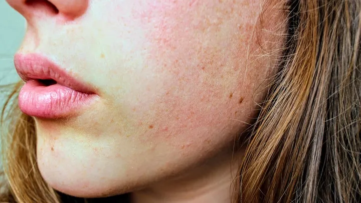 Diese 5 Hautprobleme deuten auf Vitamin D Mangel hin.