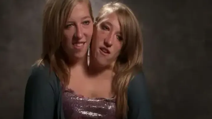 Years After These Siamese Twins Were Born, They Have Something To Share