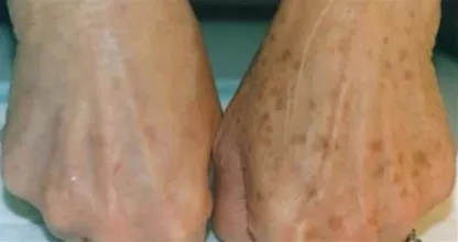 Você tem manchas de idade na sua pele? Com este truque simples elas podem desaparecer!