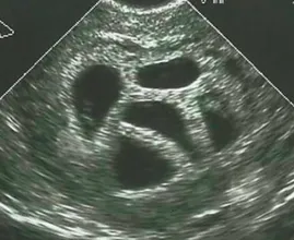Esta madre se negó a abortar sus quintillizos. Veinte años después, ¡muestra esta imagen! ¡Wow esto es increíble!