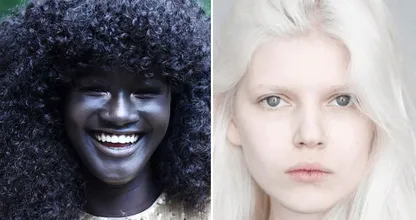 20 People With Unique Genetic Traits That Are Hard to Forget