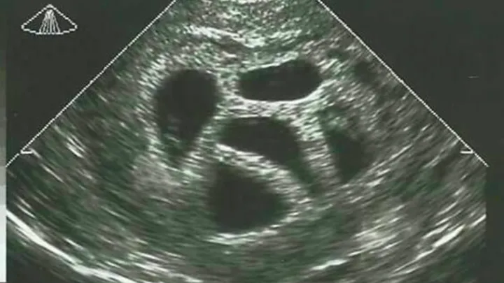 This mom refused to abort her quintuplets. Twenty years later, she shows this picture! Wow, this is amazing!