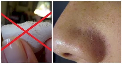 Wenn du diesen Trick gelesen hast, wirst du nie wieder Nasenstrips aus dem Laden kaufen!