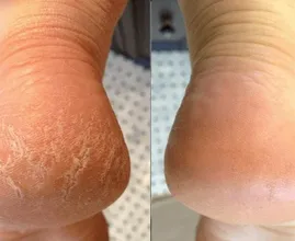 Questo prodotto economico che hai nella dispensa della cucina può aiutarti a ridurre i talloni screpolati