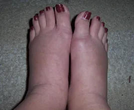 She retained a lot of water in her feet but that disappeared after following these 6 tricks!