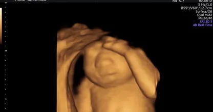 BIZAR: koppel laat niet levensvatbare baby tóch ter wereld komen voor orgaandonatie..