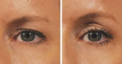 Leidest du unter hängenden Augenlidern? Dann schau dir DAS hier einmal an! Natürliches Lifting mit.... ?