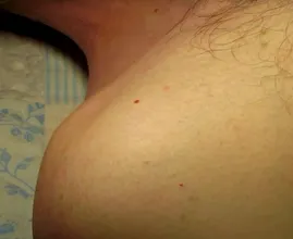 Dermatologues : Voici comment enlever ces "grains de beauté" rouges