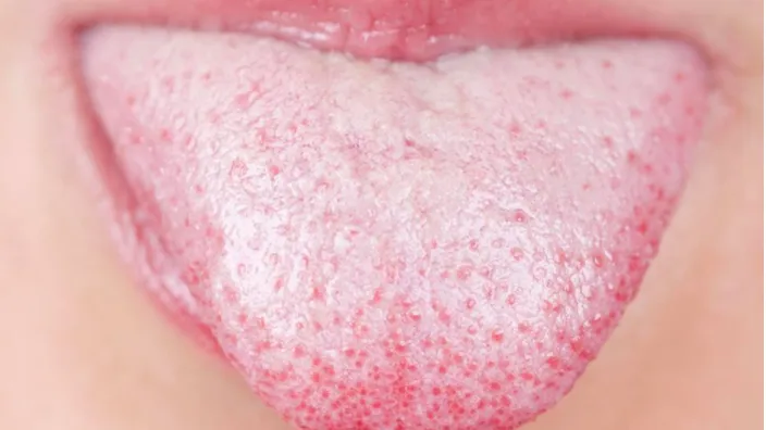 THIS is what a white tongue says about your health! Very few people know this!