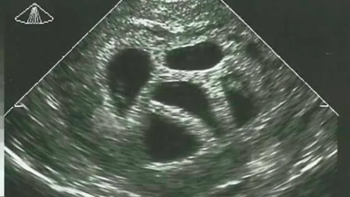 Esta madre se negó a abortar sus quintillizos. Veinte años después, ¡muestra esta imagen! ¡Wow esto es increíble!