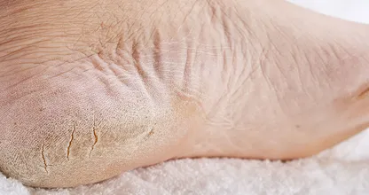 Molestas y dolorosas: ¡ fisuras en el talón ! Este remedio natural brinda alivio instantáneo