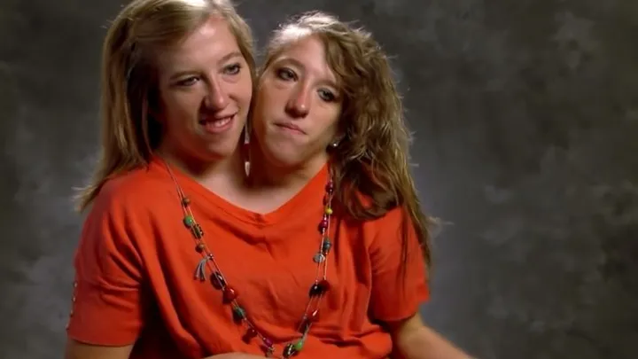 Years After These Siamese Twins Were Born, They Have Something To Share