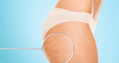 Een groot deel van de bevolking heeft last van cellulitis. Hoe kom je er van af? We hebben een trucje!