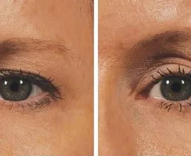 ¿Sufres de párpados caídos? ¡Entonces echa un vistazo a ESTA maravilla! ¿Levantamiento natural con...?